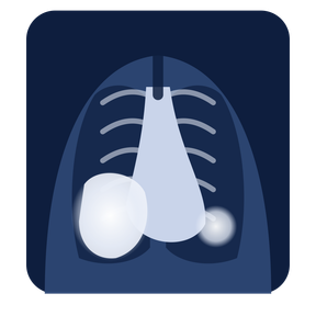 Cartoon chest X-ray showing a lung opacity